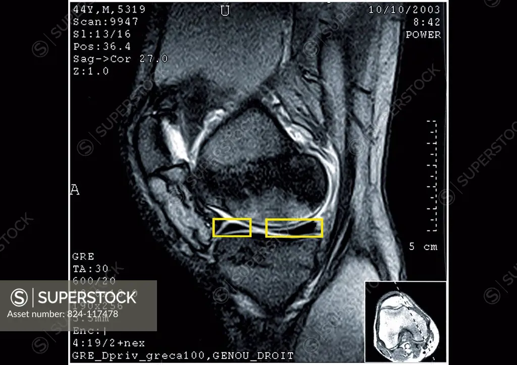 MRI scan of the left knee showing the largely damaged internal miniscus. The patient will have to undergo arthroscopy.