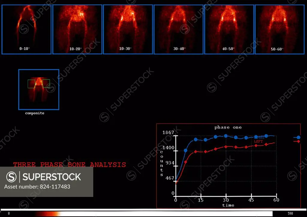 Dynamic bone scintiscan of a 63_year old woman´s pelvis. No anomaly.