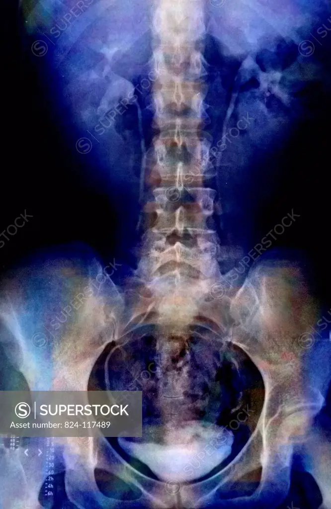 X_ray of the pelvis and lower back of a 25 years old woman. Light discopathy on L4_L5 and L5_S1