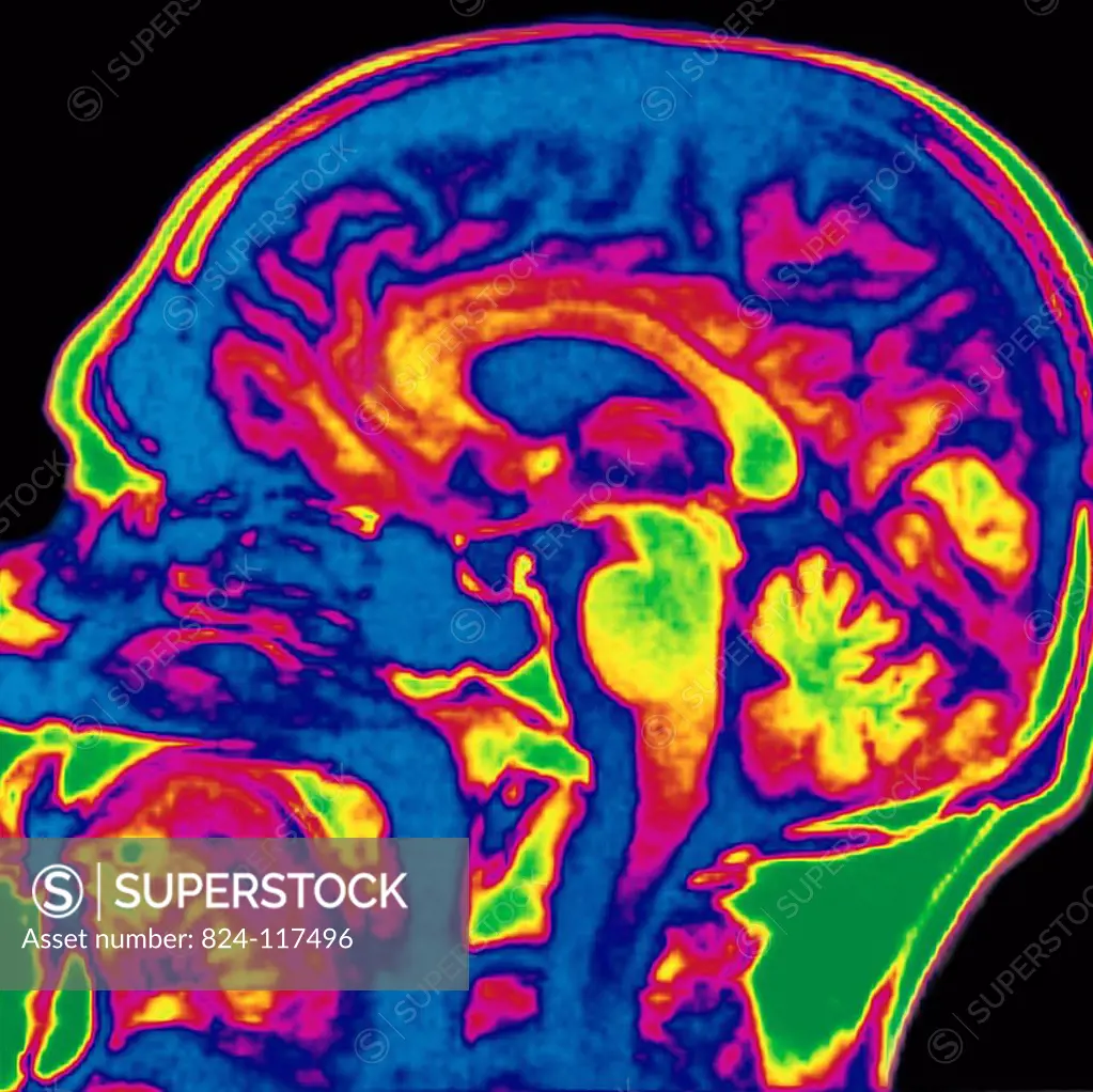 Colorised Brain RMN. Normal