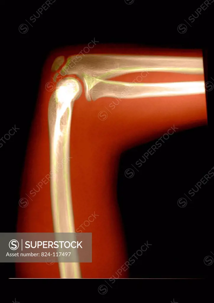 Determining the bone age of a 15_year old teenager by x_raying the elbow. The bone age is 13 years and 4 months.