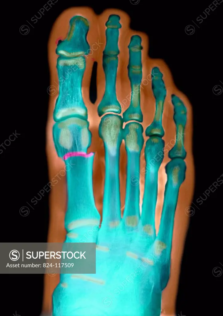 X ray of the left foot of a 29 years old male patient. Fracture of the first metatarsal bone.