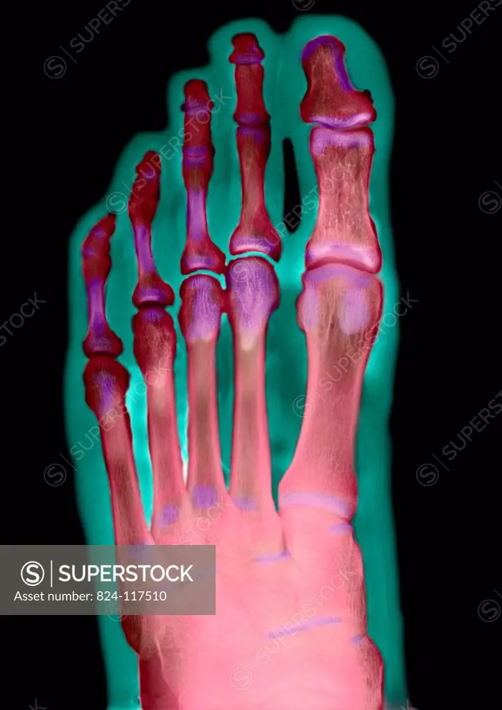 X ray of the left foot of a 29 years old male patient. Normal
