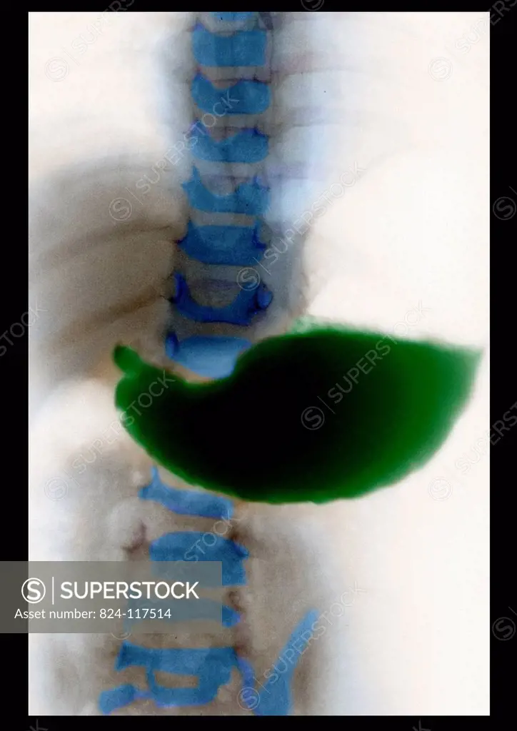 X_ray of a young child´s stomach. No anomaly of the digestive system.
