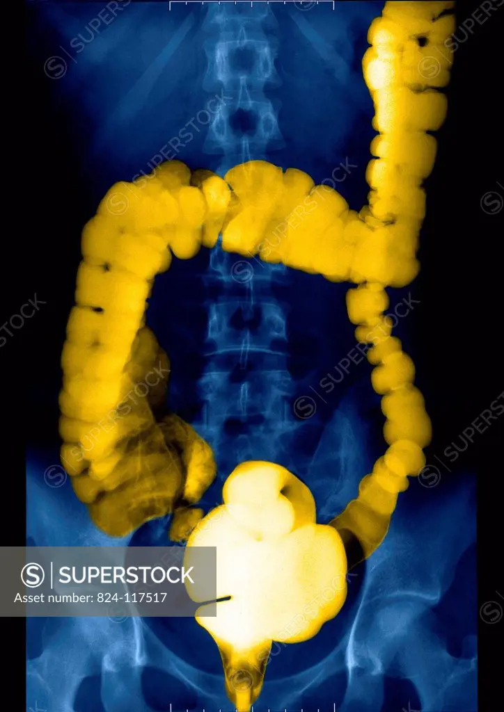 Barium enema of a 30_year old patient´s intestines. X_ray normal.