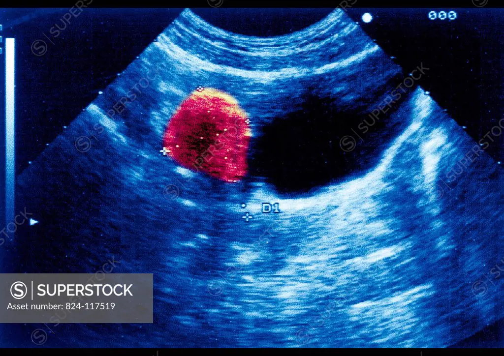 Ultrasound scan of a 26_year old patient´s ovary. No discernible pathology.