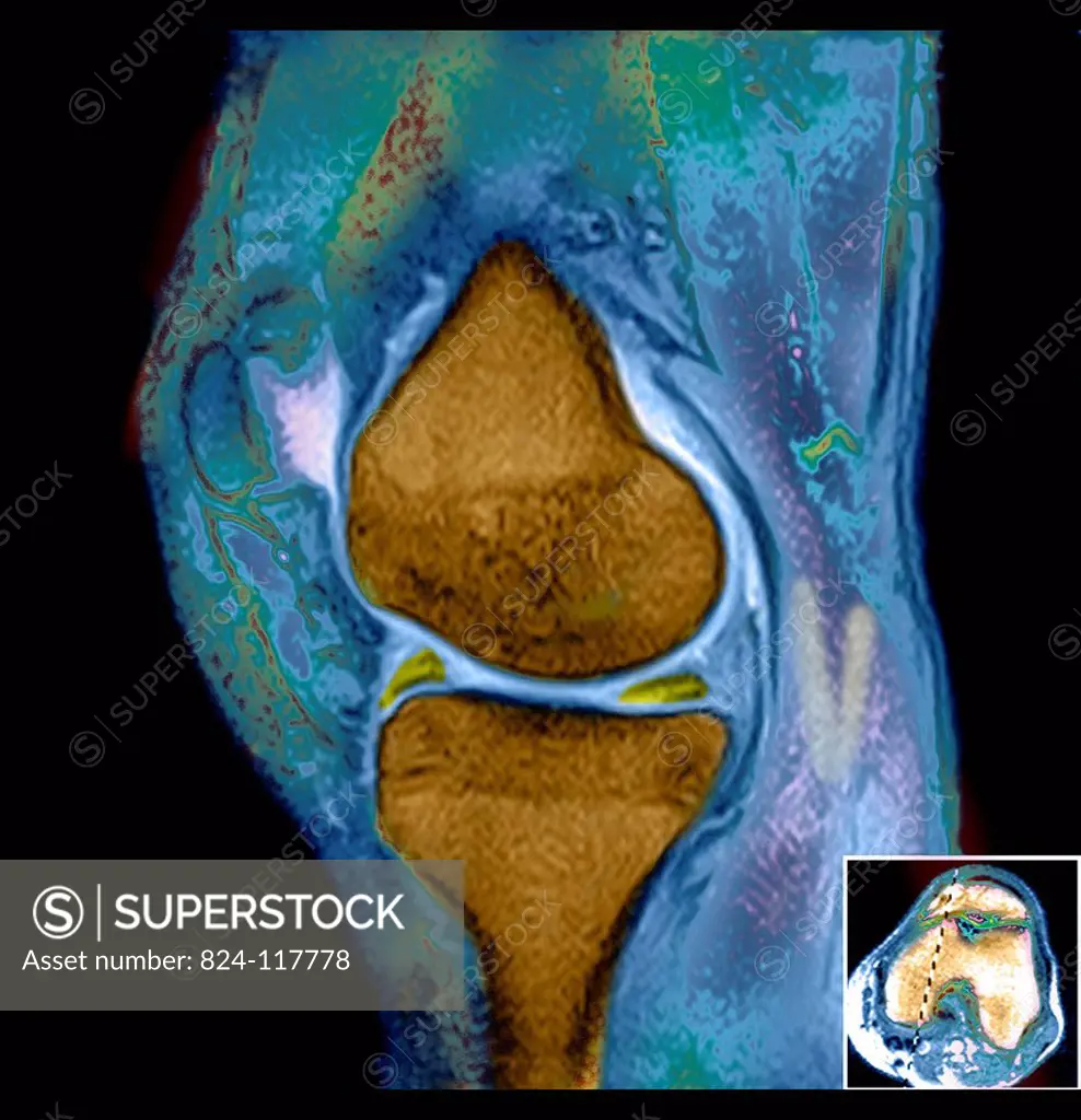 MRI scan of the left knee. The patient underwent arthroscopy to remove part of the damaged meniscus.