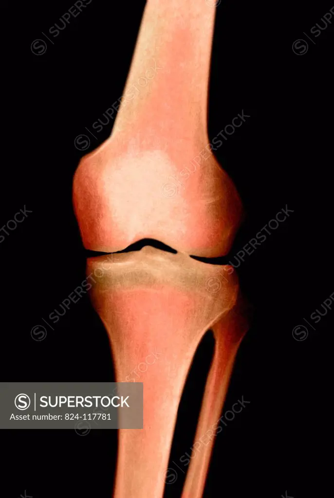 X_ray of a 30_year old man´s left knee. No anomaly.