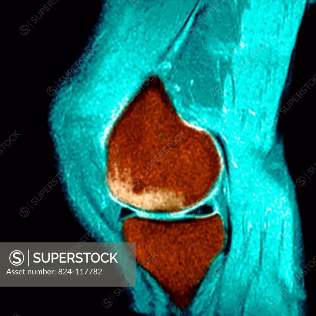 Severe osteonecrosis of the knee of a 78 years old patient. RMN