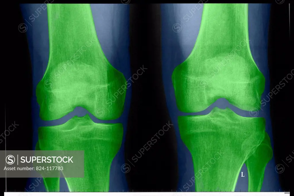 Normal knee x_ray.