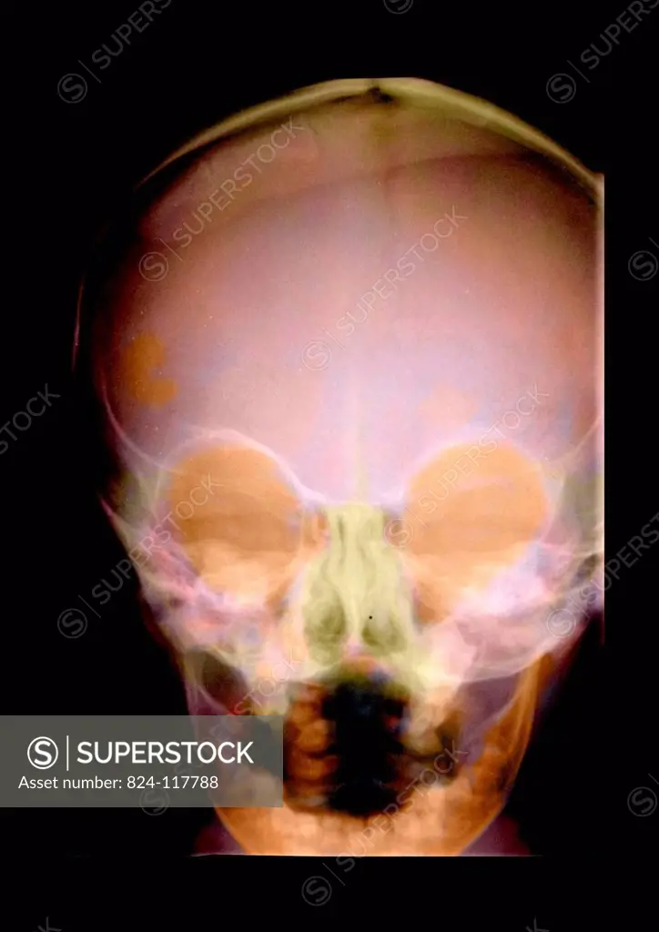 X_ray of a child´s sinuses. Normal.