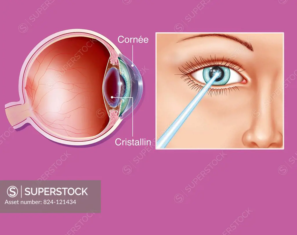 Illustration of laser eye surgery, used in various pathologies such a short-sightedness, presbyopia etc.