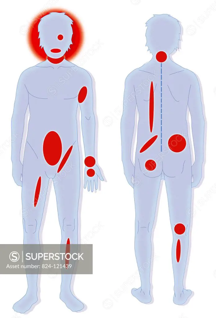 Illustration of parts of the body susceptible to dangerous hematomas in hemophiliacs that require instant medical attention. Hematomas of the pharynx,...