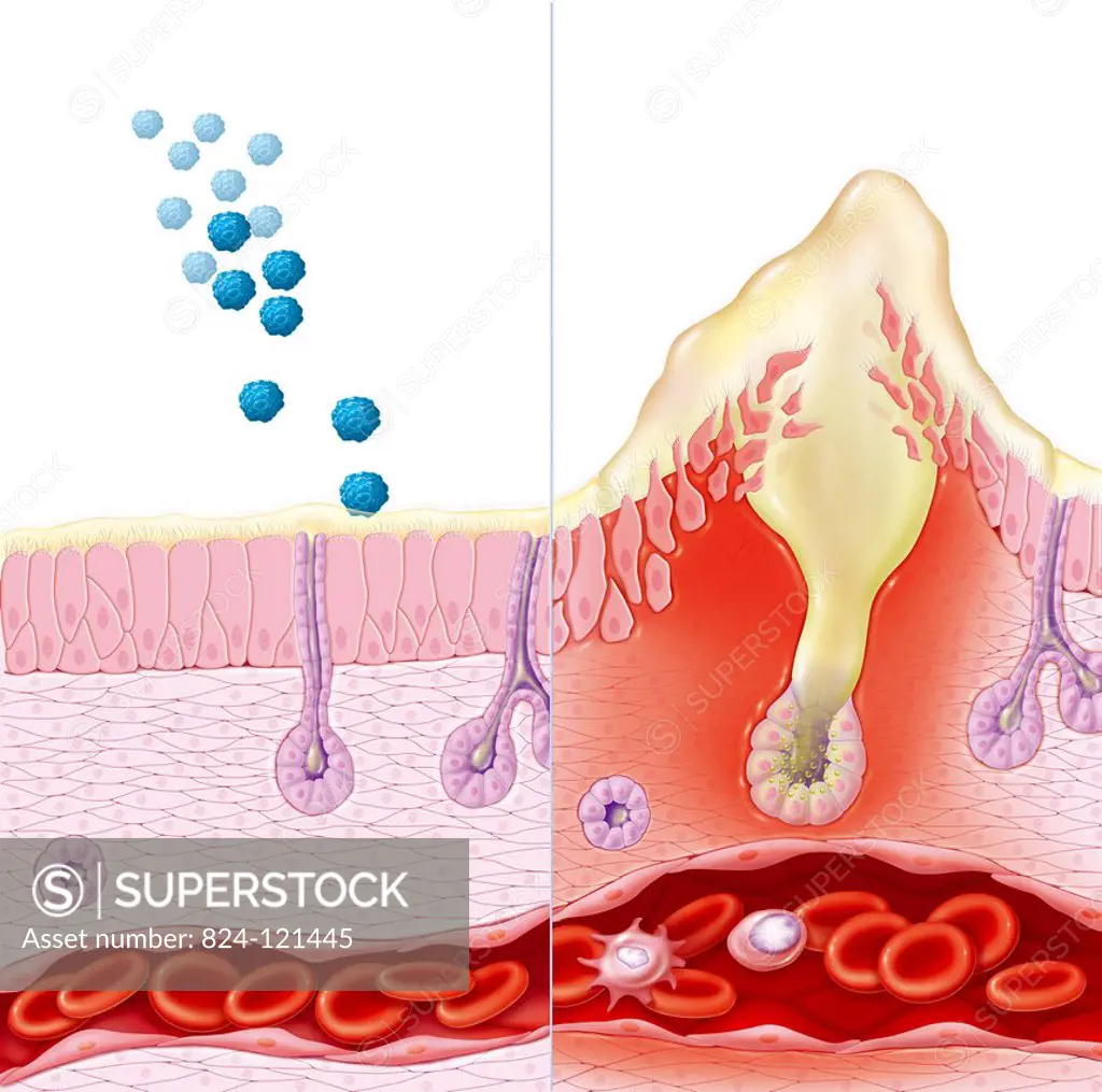 Illustration of a healthy nasal mucous membrane coming into contact with allergens (on the left) and the reaction that follows infection (on the right...