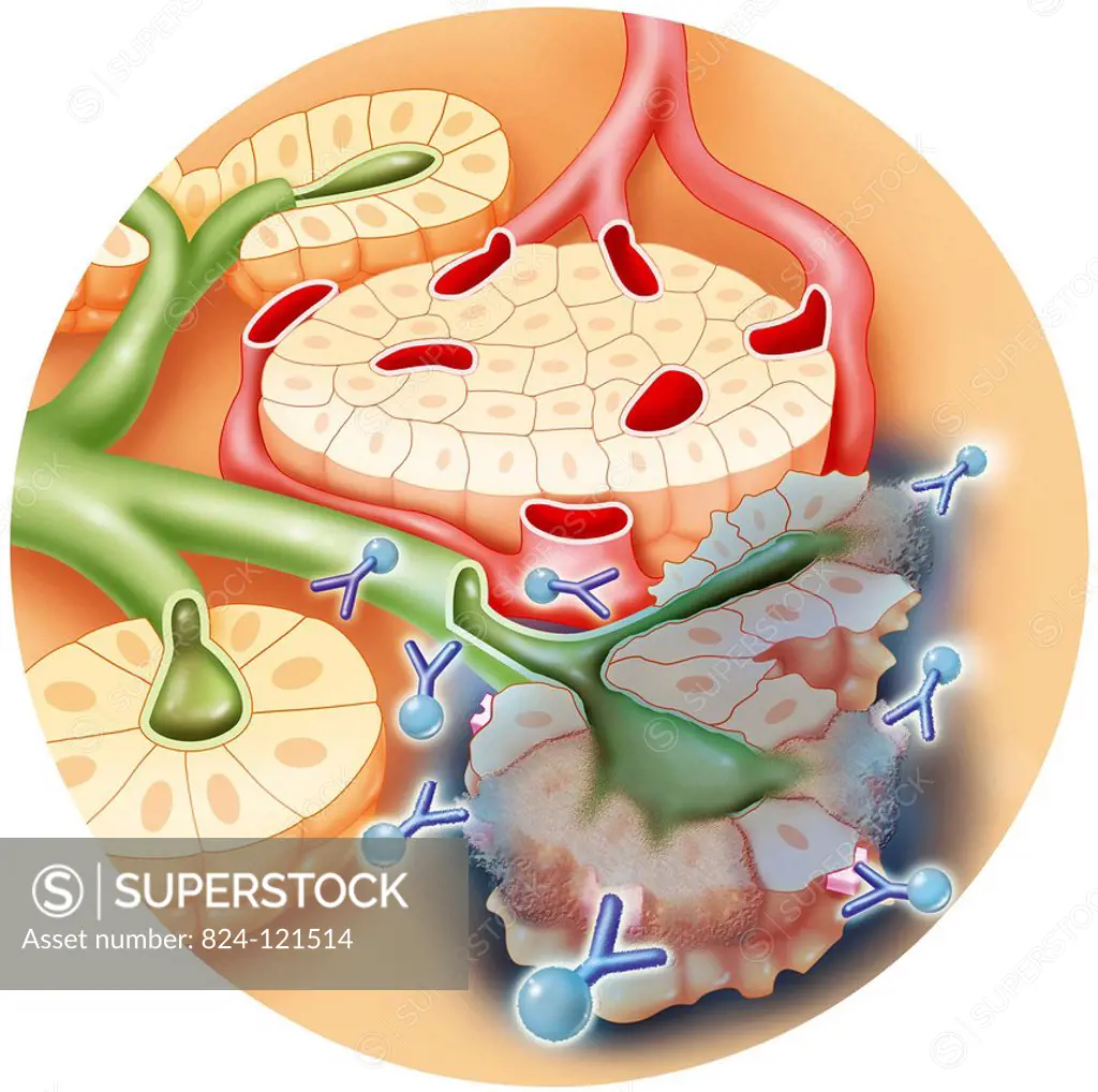 Illustration of radioimmunotherapy used to treat pancreatic cancer. A radioactive isotope (lead-212) is combined with a specific antibody capable of t...