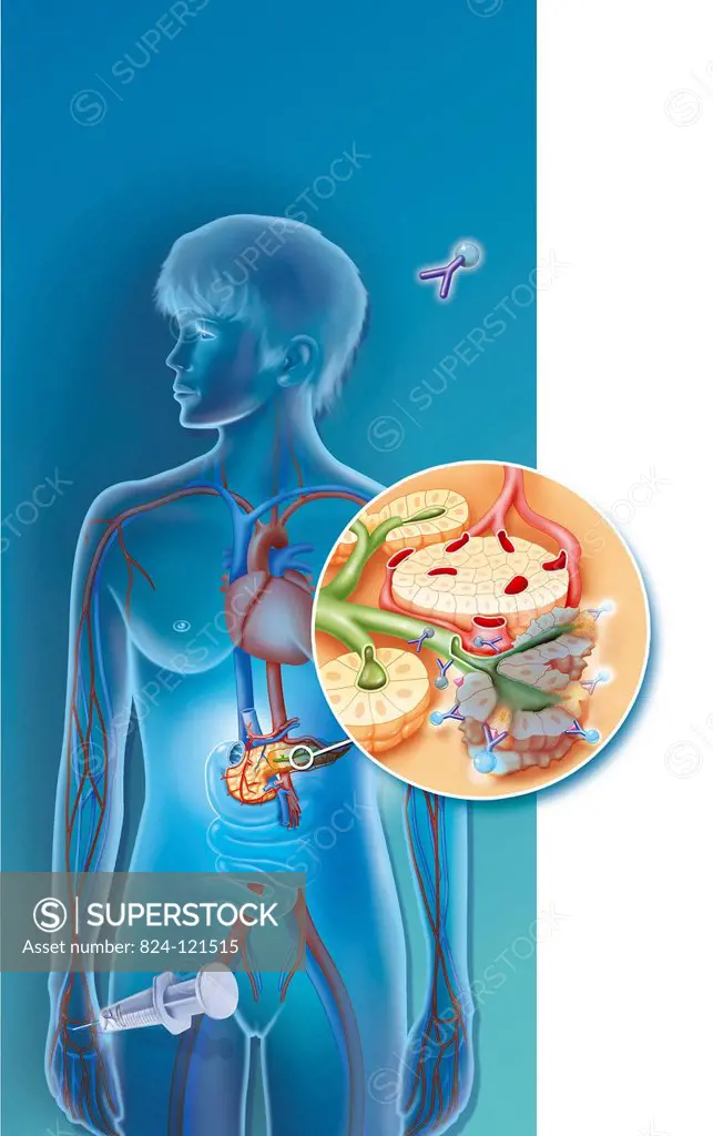 Illustration of radioimmunotherapy used to treat pancreatic cancer. A radioactive isotope (lead-212) is combined with a specific antibody capable of t...