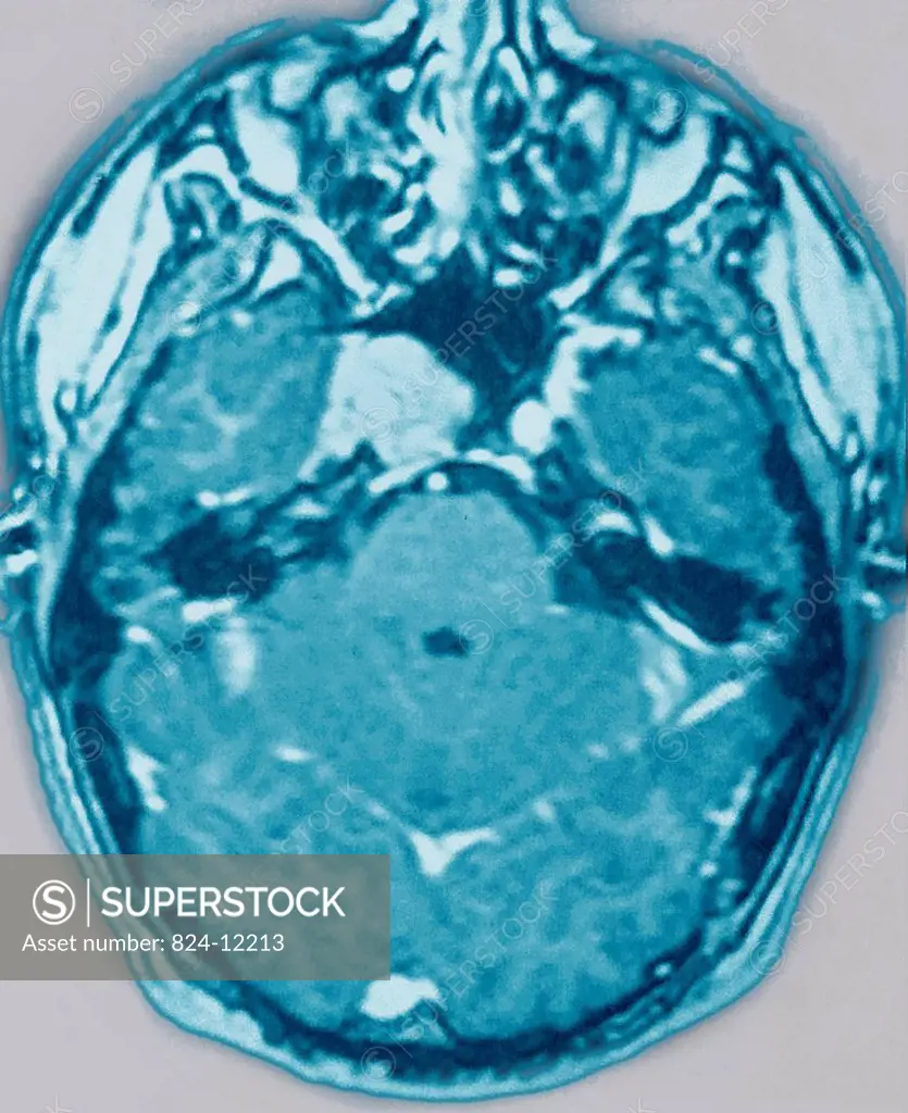 Hypophyseal tumor is an abnormal growth in the pituitary gland which may cause endocrine disorders. Axial CT scan of the brain.