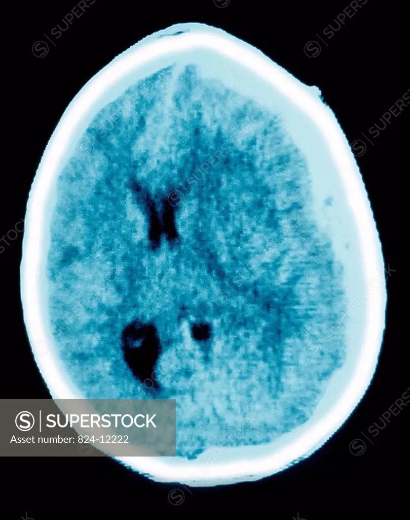 Axial CT scan of the brain showing a subdural hematoma, a collection of blood between the dura and the arachnoid.
