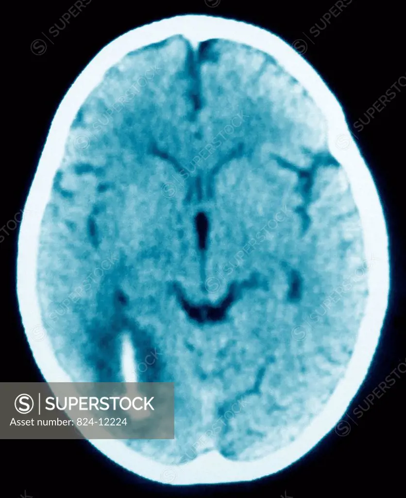 Intracerebral hemorrhage ICH, a type of stroke caused by bleeding within the brain tissue. Axial CT scan of the brain.