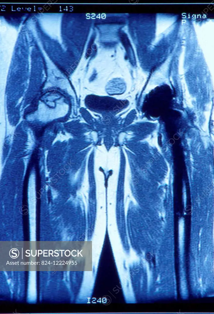 this frontal mri image reveals an osteonecrosis (bone death) of the hip.