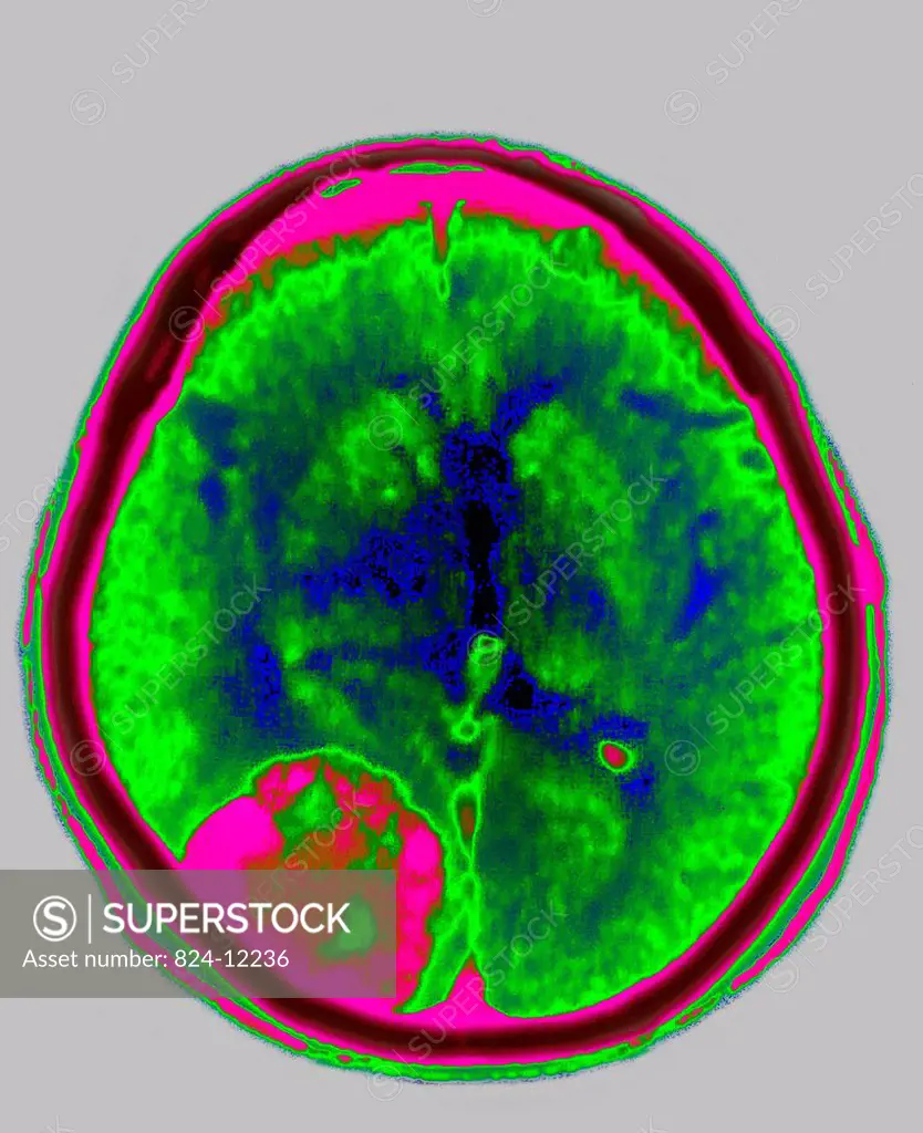 Axial CT Scan of the brain showing a meningioma.