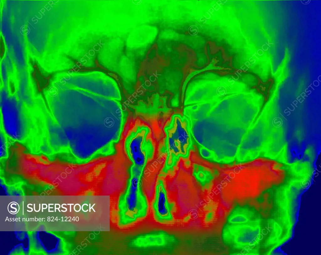 X_ray of the skull showing sinonasal polyposis.