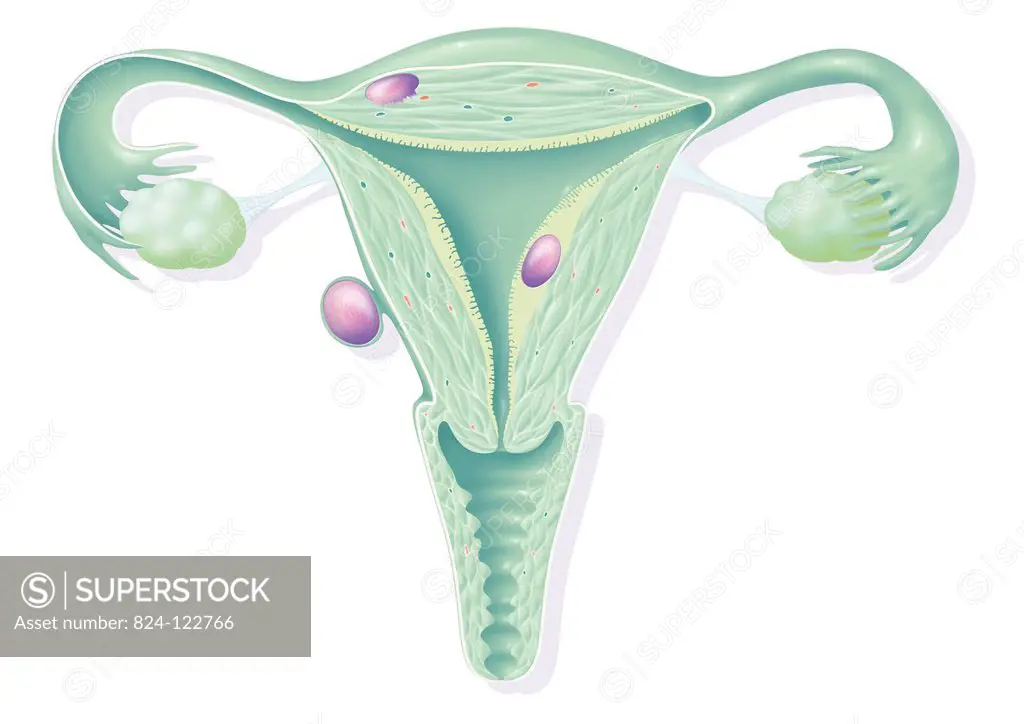 Illustration of 3 types of uterine fibroids. - at the top, the intramural fibroid which is the most common. It develops in the muscle layer of the wal...