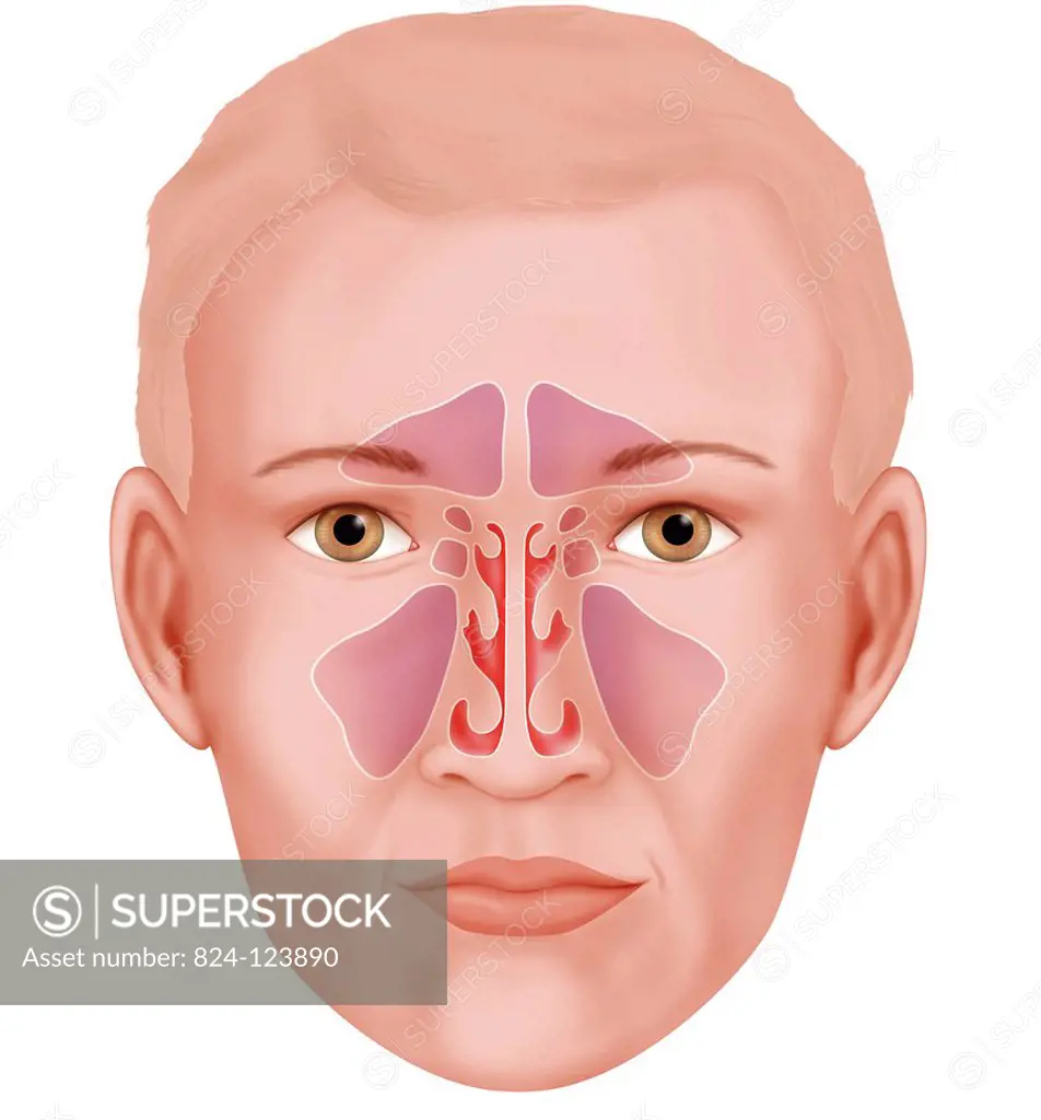 Illustration of the various paranasal sinuses (purple). From top to bottom : frontal sinus (triangular), the sphenoid, ethmoidal and maxillary sinuses...