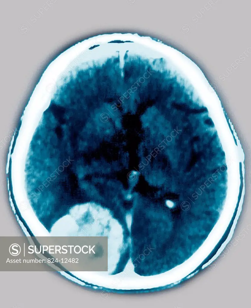 Axial CT Scan of the brain showing a meningioma.