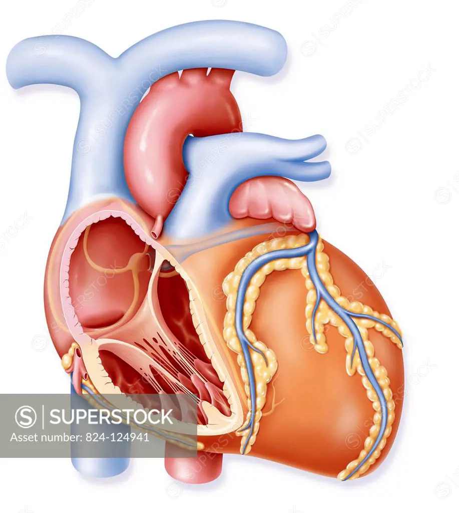 Illustration of cardiomyopathy. The thinned linings of the left ventricle (cardiac muscle) cause a malfunction of a muscle, visible on the illustratio...