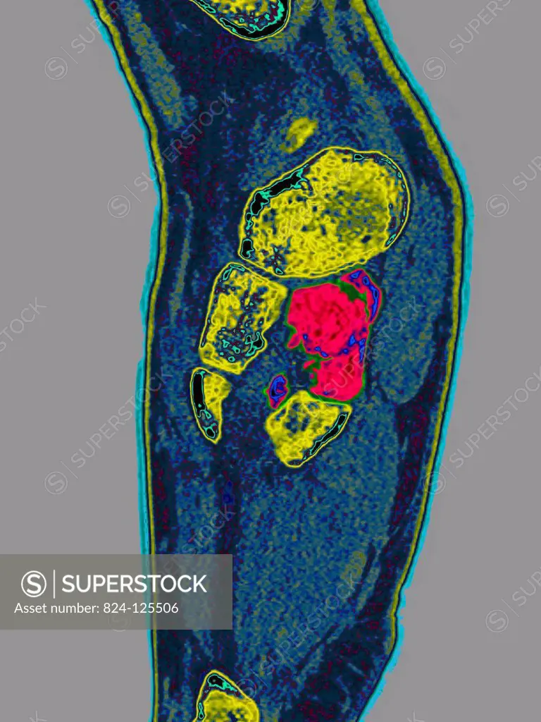 Fracture of the medial cuneiform bone in the foot. Sagittal scan of the right foot.