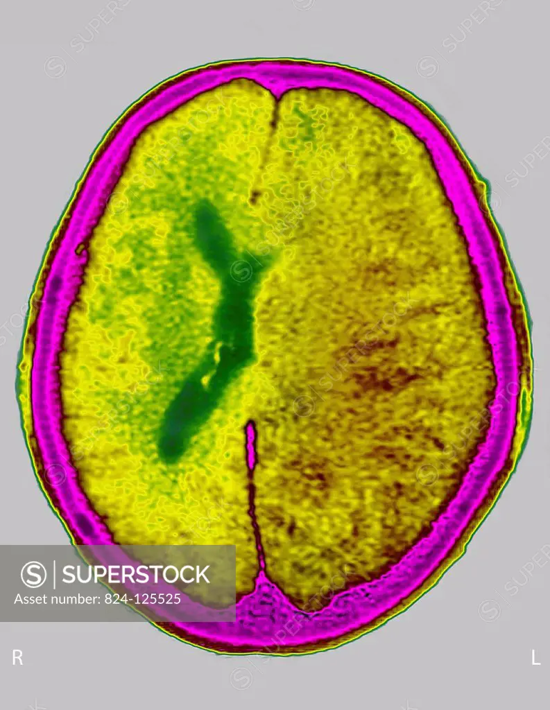 Cerebral edema (in the left hemisphere). Cross-section scan of the skull.