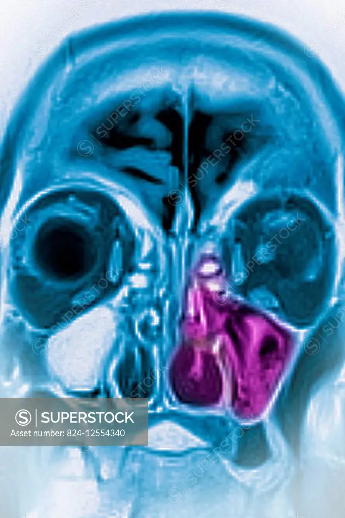 Sinusitis in the left maxillary sinus, seen on a frontal, cross-section MRI scan.