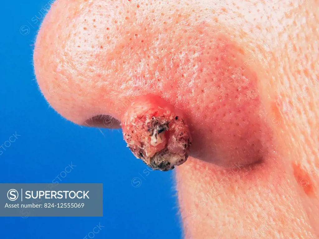 Keratoacanthoma on the side of the nostril.