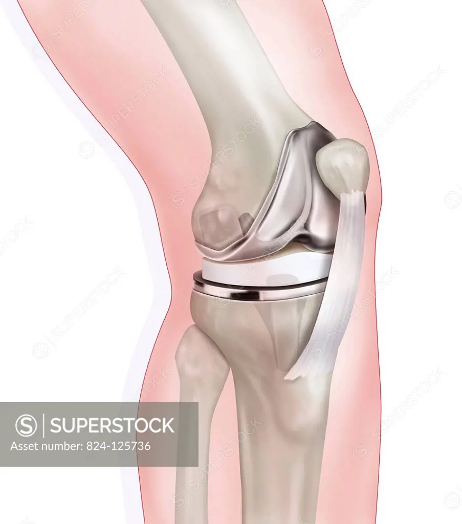 Illustration of a knee joint prosthesis. Total sliding knee prosthesis, and more precisely a prosthesis with a mobile head which replaces all the cart...