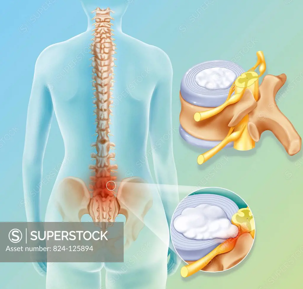 Illustration of a spinal disc herniation between L4/L5 (4th and 5th lumbar vertebrae) and L5/S1 (5th lumbar and 1st sacrum) which the roots of the sci...
