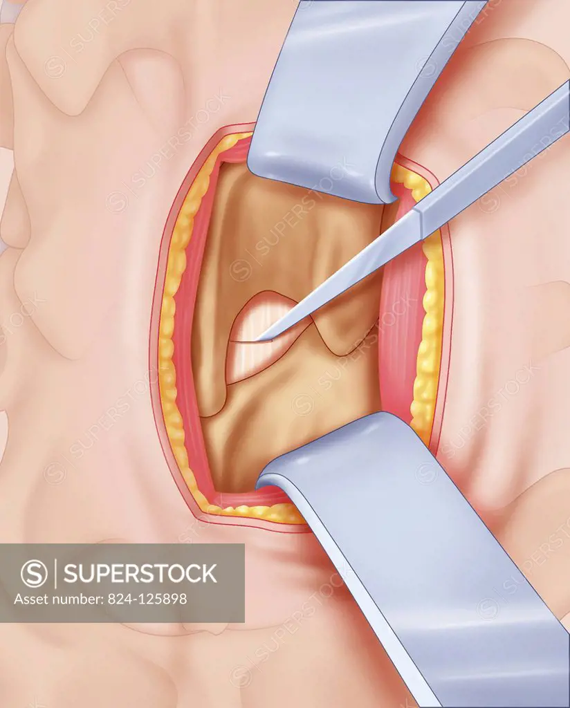 Illustration of surgical access during a classic operation for a herniated disc. The operation involves moving aside the back muscles, around the spin...
