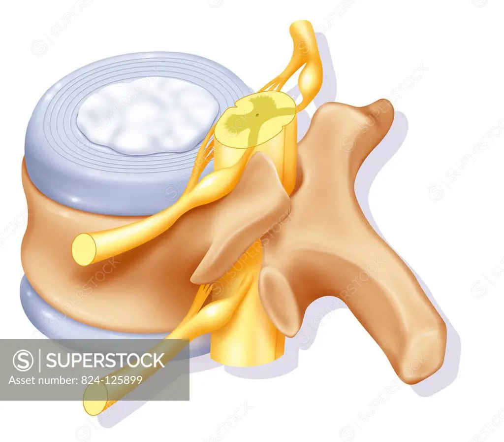 Illustration of a lumbar vertebra and its lower and upper intervertebral discs, shown from a 3/4 posterior view. The spinal cord and lumbar nerve root...
