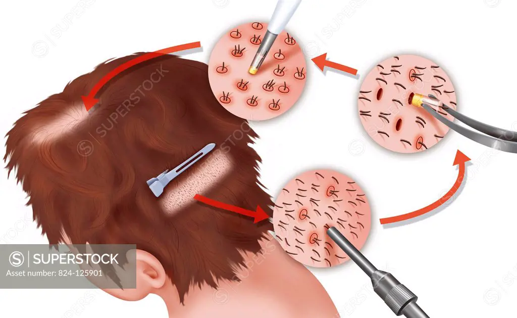 Illustration of follicular unit extraction (FUE), a hair transplant technique used for small areas of hair loss. The technique involves removing folli...
