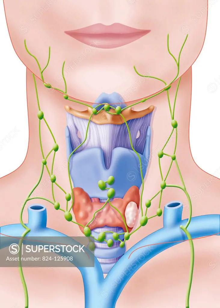 Illustration of a thyroid nodule on the right lobe of the thyroid gland. These nodules mainly affect women and are mostly benign, but need to be watch...