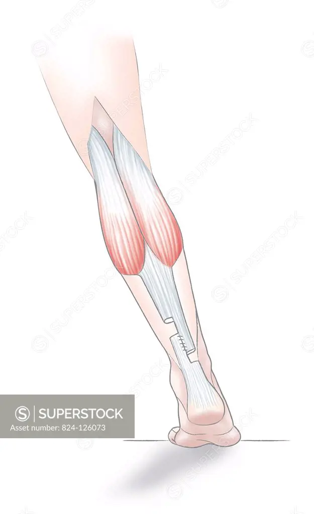 A technique for lengthening the Achille's tendon.