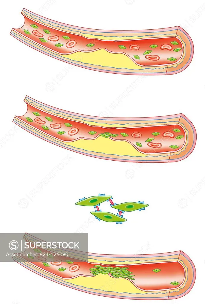 Stages of platelet aggregation following the formation of an atheromatous arterial plaque.