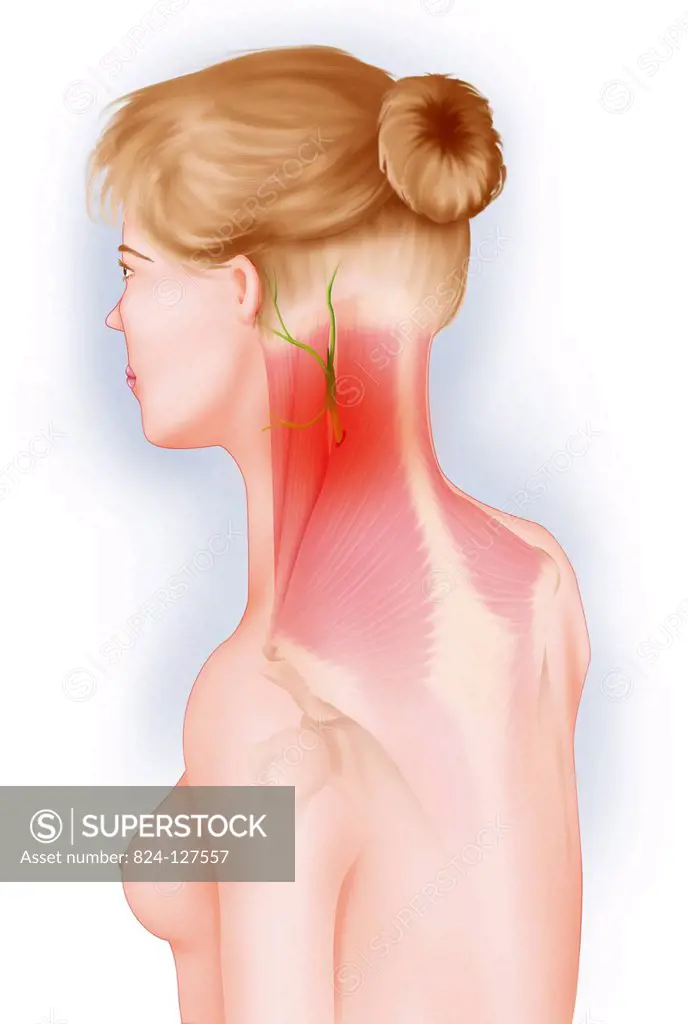 Illustration of the mucles and nerves involved in a stiff neck. A stiff neck is painful due to neck muscles contracting. The muscles contract and trap...