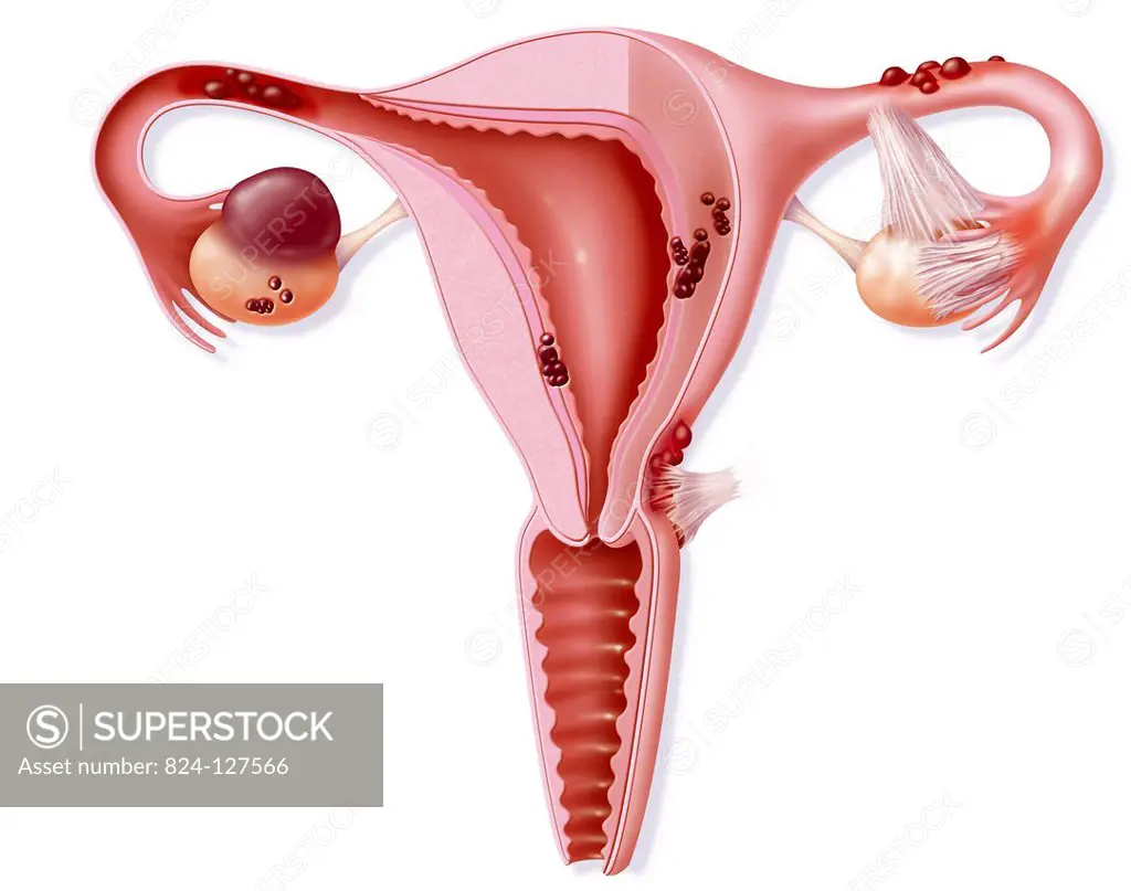 Illustration of endometriosis (the presence of endometrial tissue outside the uterine cavity). It can take the shape of small nodules (on the fallopia...