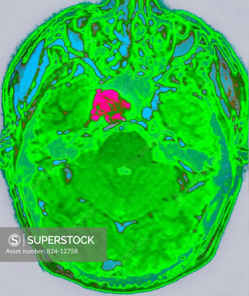 Hypophyseal tumor is an abnormal growth in the pituitary gland which may cause endocrine disorders. Axial CT scan of the brain.