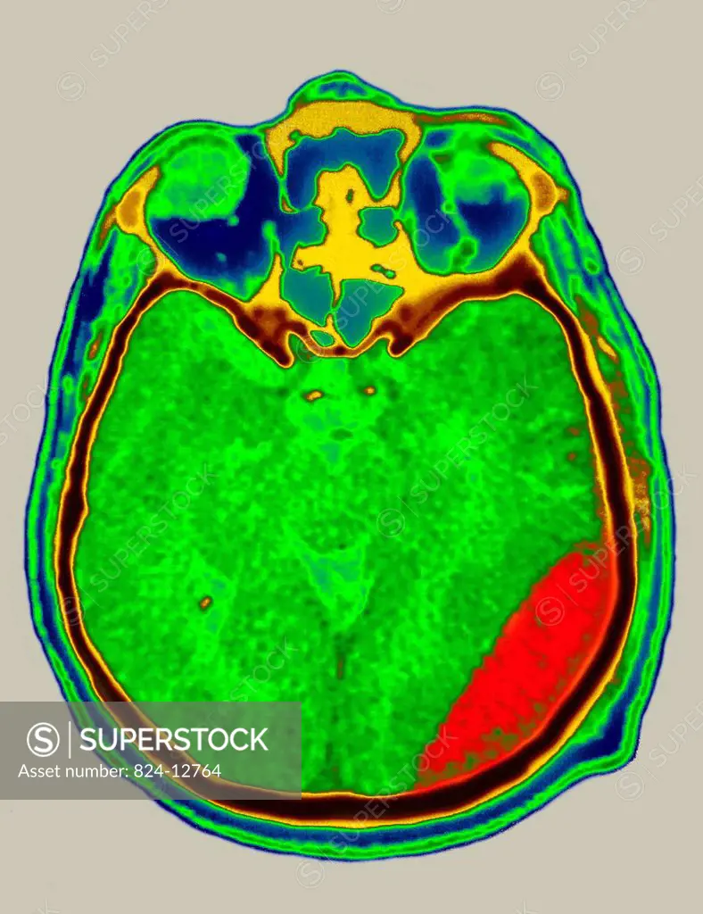 Cerebral CT scan showing epidural extradural hematoma, a type of traumatic brain injury.