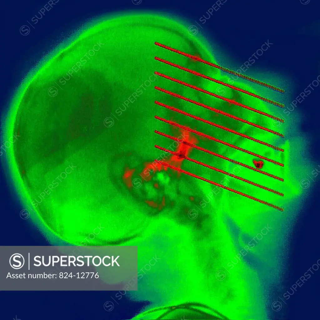 CT scan of nasal cavities coronal slices.