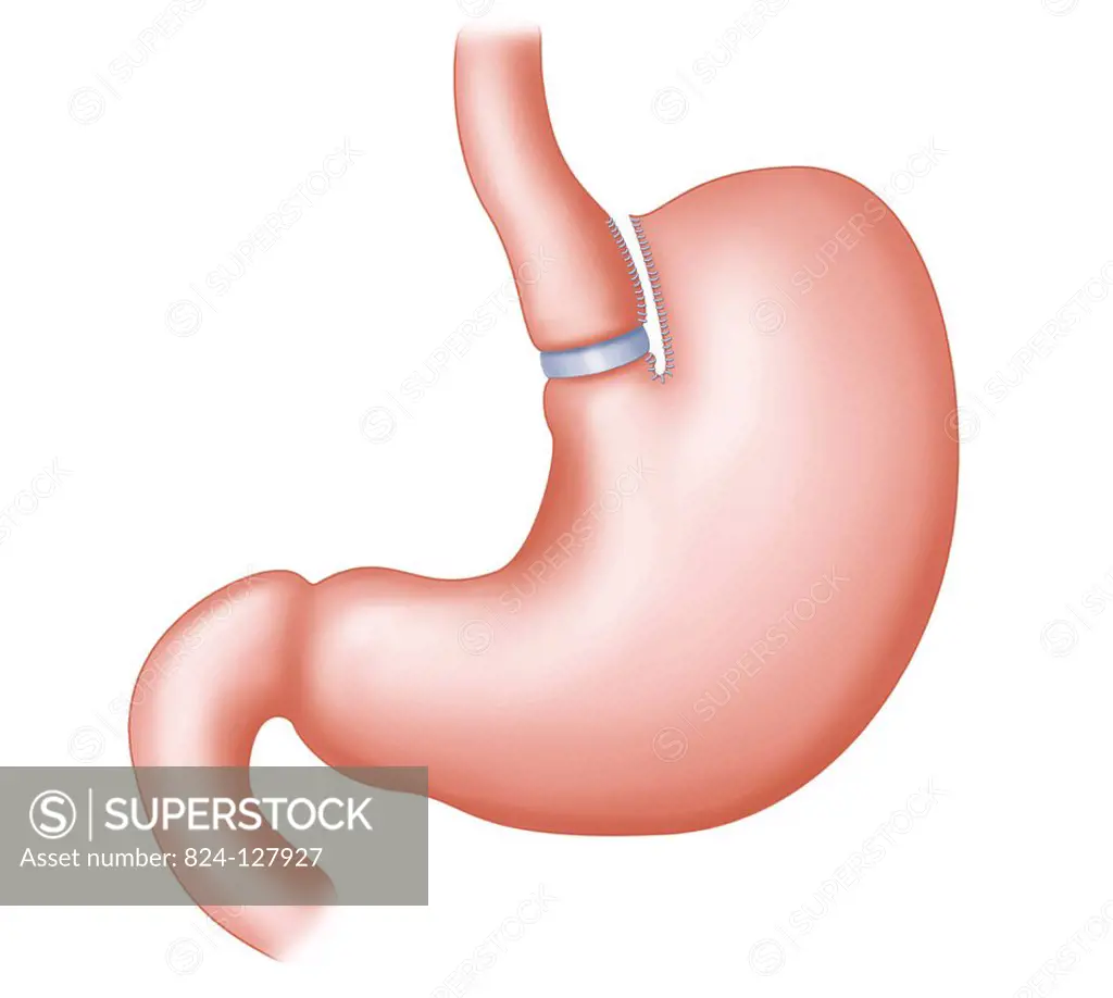 Illustration of vertical banded gastroplasy, surgical treatment for obesity (bariatric surgery). It involves reducing the side of the stomach with a g...