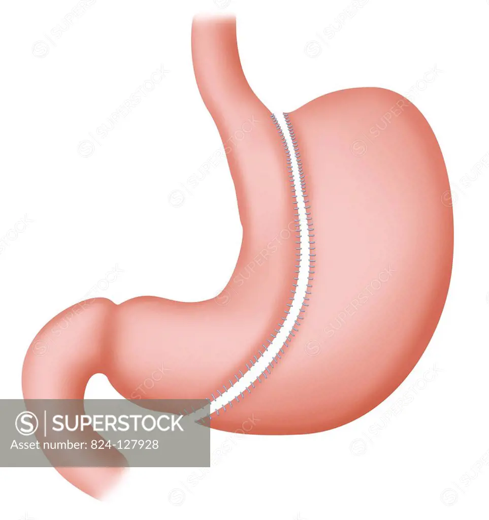Illustration of a sleeve gastrectomy. This restrictive technique involves removing roughly two thirds of the stomach. The stomach is reduced to a vert...
