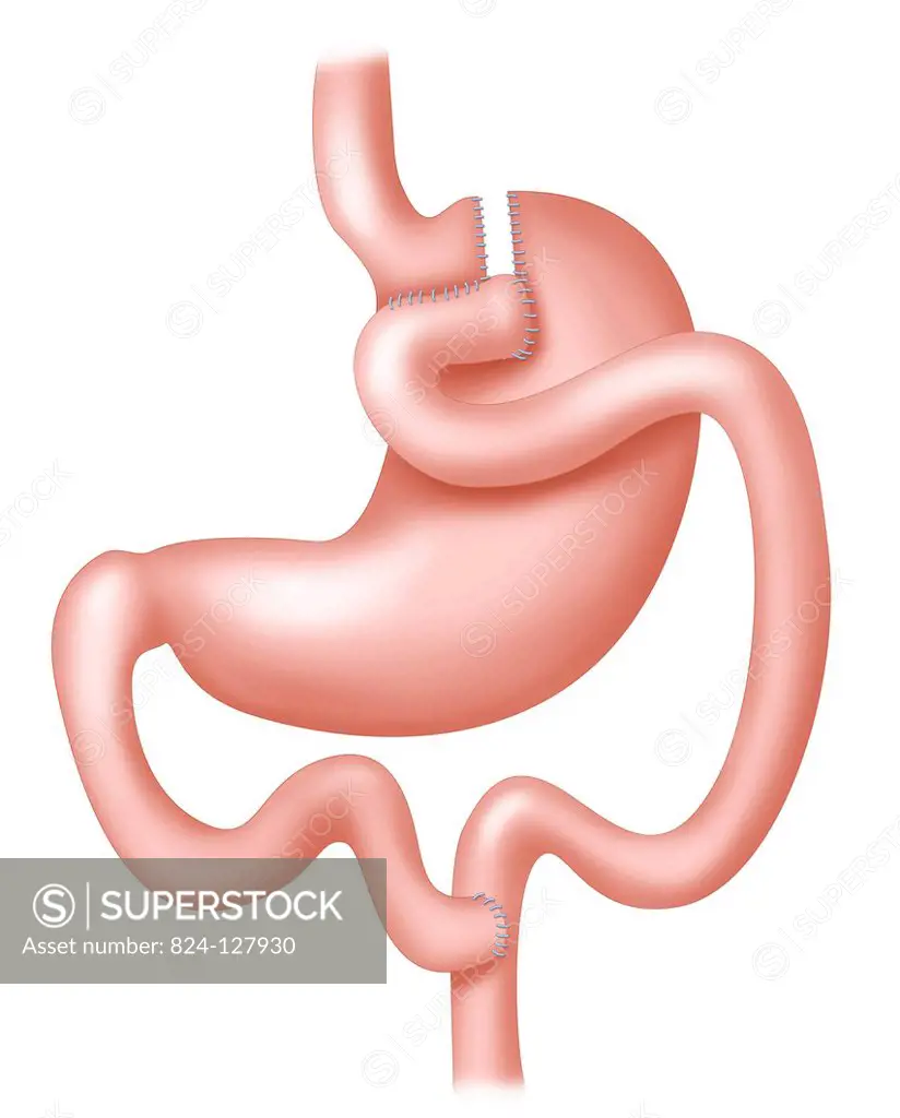 Illustration of a gastric bypass, surgical treatment of obesity. The aim of this surgery is to, on the one hand, reduce stomach capacity, and on the o...